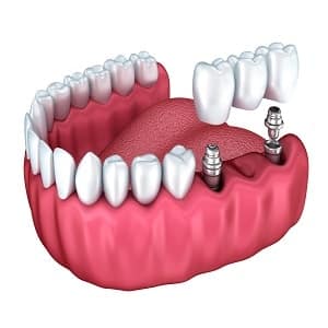 השתלות שיניים ממוחשבת