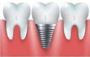 מה הטיפול הנכון אחרי עקירות שיניים