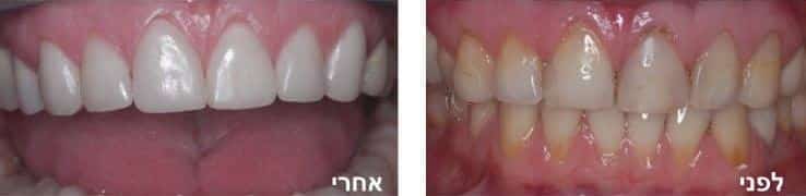 אסתטיקה בשיניים אסתטיקה בשיניים