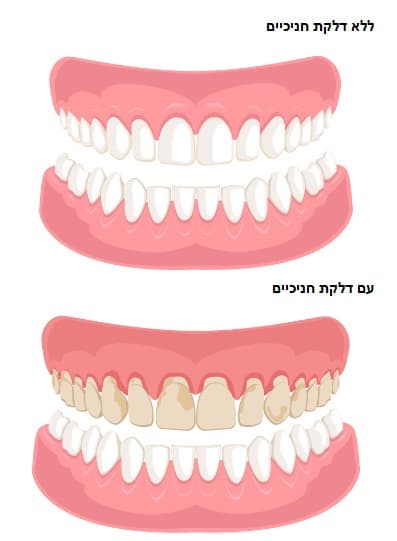 הקצעת שורשים