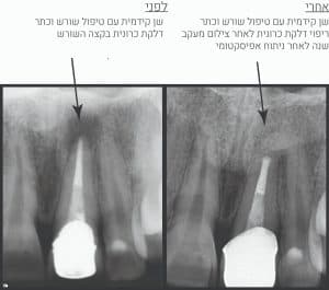 אפיסקטומי