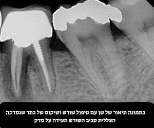 טיפול שורש ושיקום של כתר שנסדקה