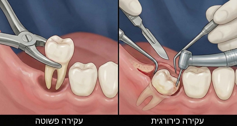 עקירות כירורגיות מה ההבדל בין עקירה רגילה לעקירה כירורגית
