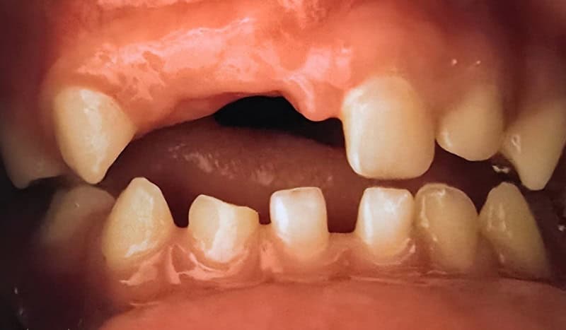 לפני השלמת שיניים לילדים לפני השלמת שיניים לילדים