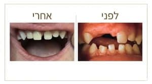לפני ואחרי השלמת שיניים לילדים