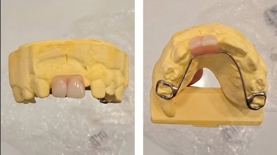 פלטה לילדים השלמת שיניים פתרון מושלם פלטה לילדים השלמת שיניים פתרון מושלם